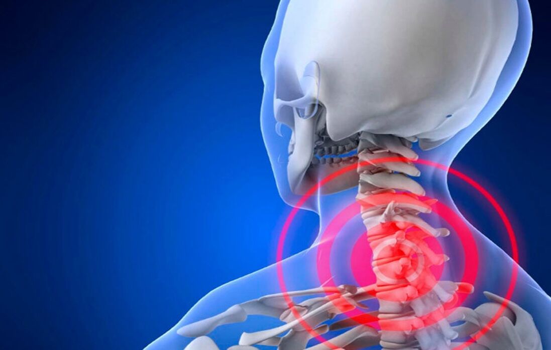 Osteocondrose da região cervical